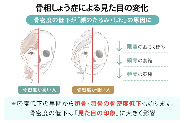 骨粗しょう症による見た目の変化