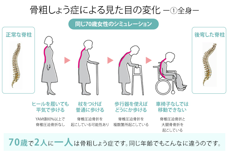 骨粗しょう症
